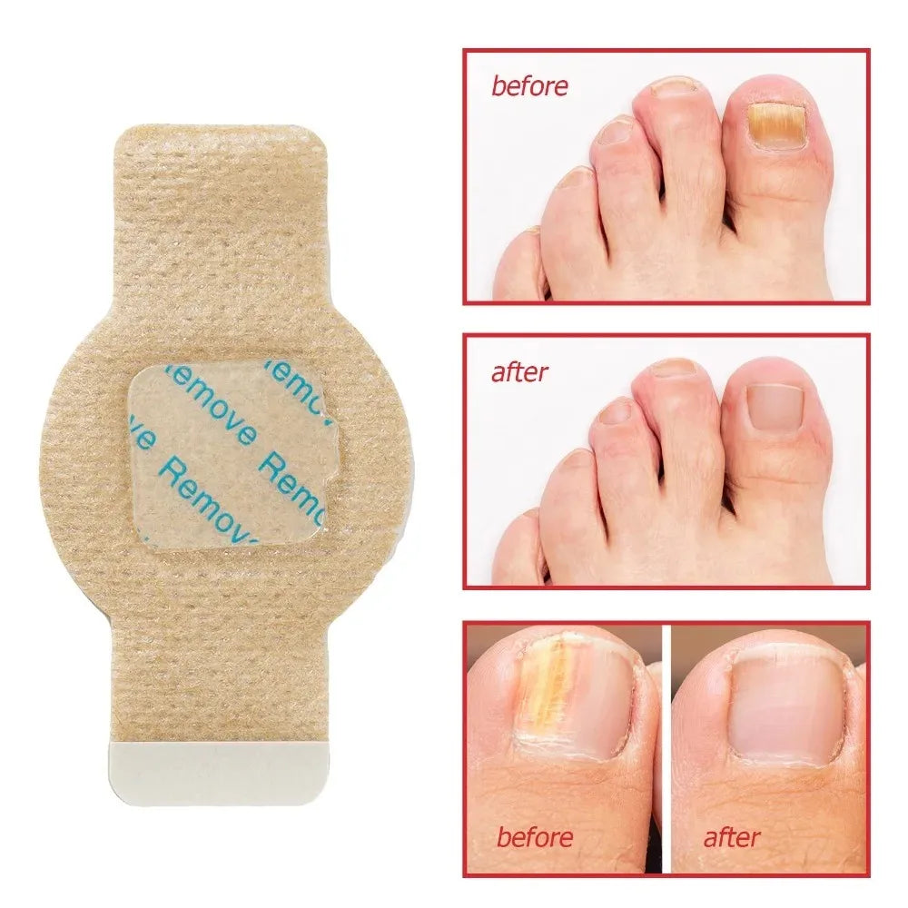 A package of waterproof nail fungus repair patches showing before and after results on a foot and toenail.